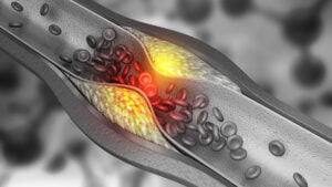 EsSalud adquirirá “stent” para la atención de pacientes con accidentes cerebrovasculares