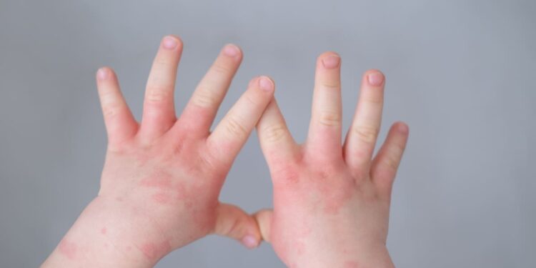 Comisión Europea aprobó tratamiento para dermatitis atópica en niños