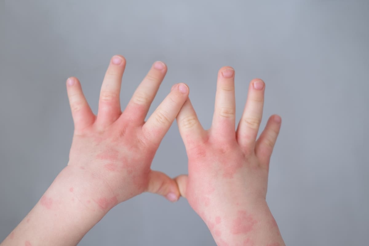 Comisión Europea aprobó tratamiento para dermatitis atópica en niños