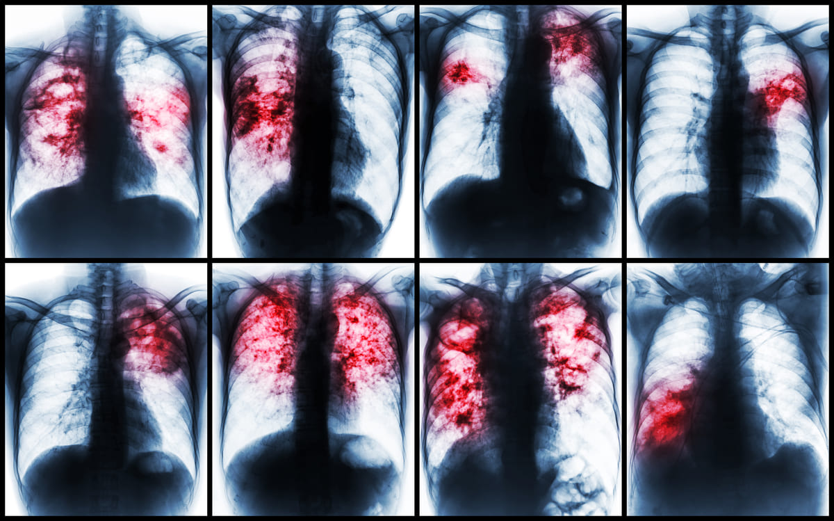 En Colombia se han presentado 450 casos de tuberculosis farmacorresistente