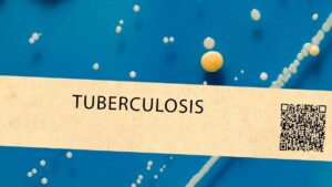 Más de 17 mil casos de tuberculosis fueron registrados en el 2022