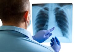 Resultados del programa de detección de cáncer de pulmón
