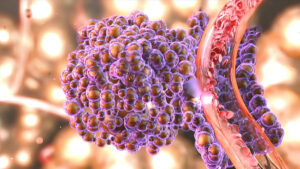 Tratamiento dirigido a las metástasis obtuvo mejores resultados en cáncer de próstata