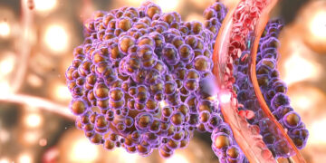 Tratamiento dirigido a las metástasis obtuvo mejores resultados en cáncer de próstata