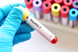 Hepatitis C: Síntomas, causas, diagnóstico y tratamiento