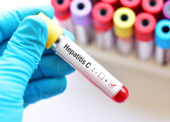 Hepatitis C: Síntomas, causas, diagnóstico y tratamiento
