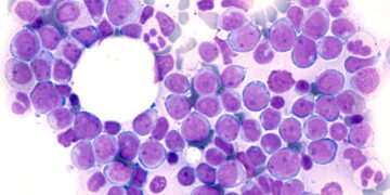 FDA aprueba nuevo medicamento para leucemia mieloide aguda