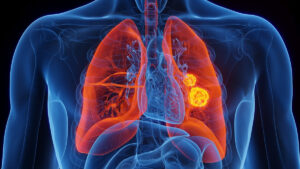 Quimioinmunoterapia cáncer de pulmón