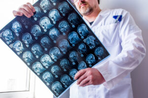 Epilepsia focal Mapeo de lesiones podría mejorar diagnósticos y tratamiento