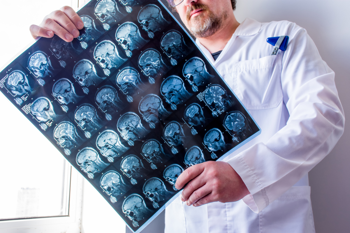 Epilepsia focal Mapeo de lesiones podría mejorar diagnósticos y tratamiento