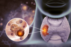 Firma molecular que predice el cáncer de tiroides agresivo