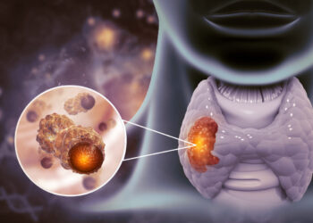 Firma molecular que predice el cáncer de tiroides agresivo