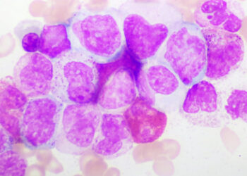 Lo que debes saber sobre la leucemia mieloide crónica (LMC)