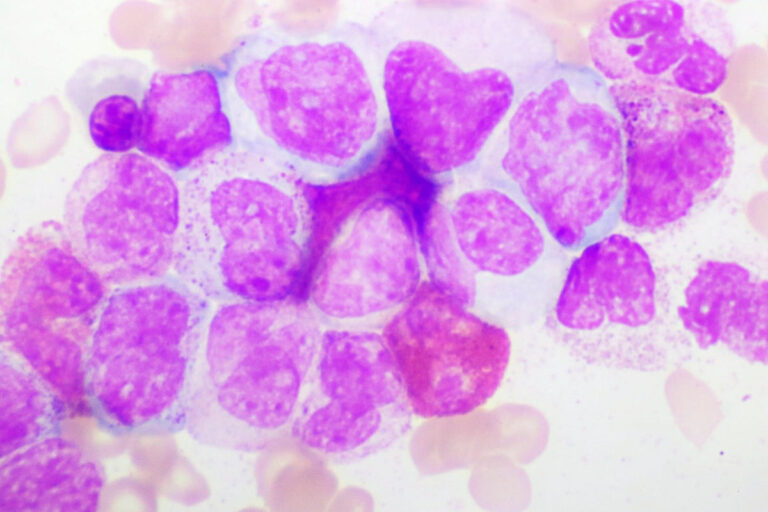 Lo que debes saber sobre la leucemia mieloide crónica (LMC)