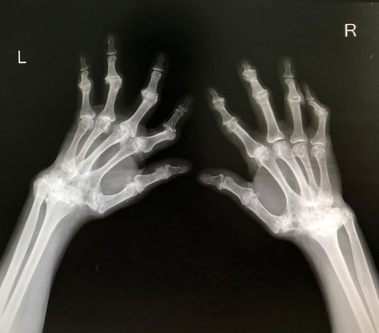 Carga mundial de la artritis reumatoide: desafíos y proyecciones hasta 2050