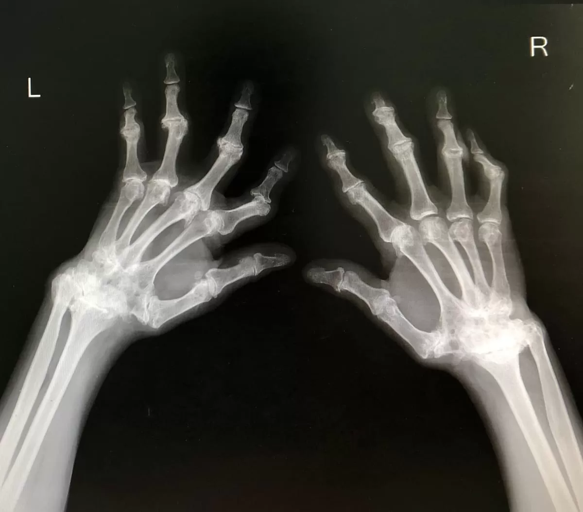 Carga mundial de la artritis reumatoide: desafíos y proyecciones hasta 2050