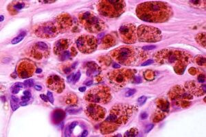 Revelan desacierto en el enfoque de terapia celular con macrófagos