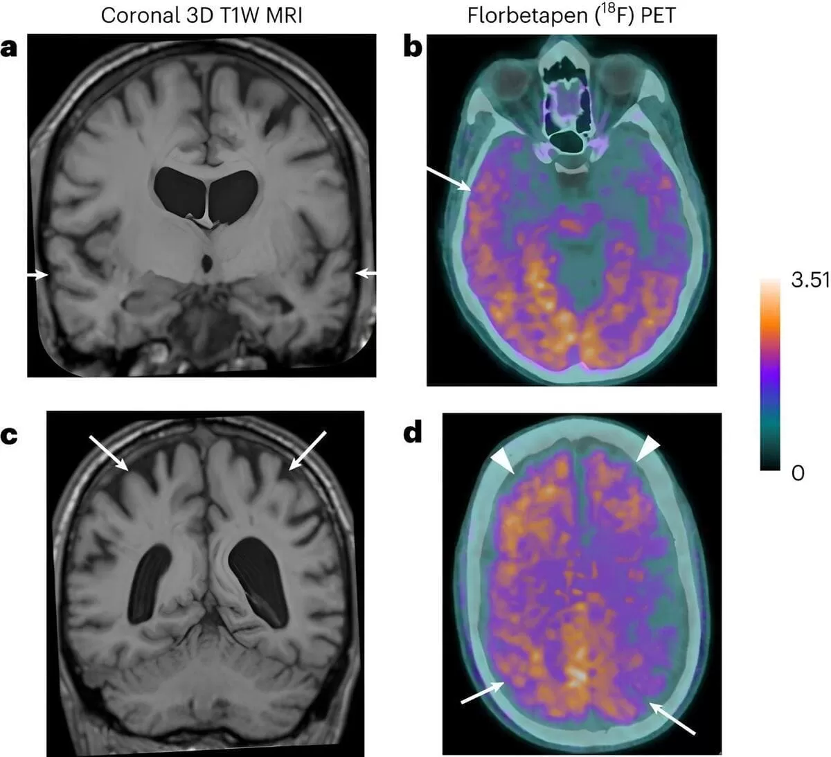 Investigadores descubren casos de enfermedad de Alzheimer adquirida
