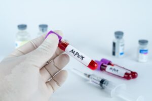 Colombia y Japón se unen en histórico estudio de vacuna contra el Mpox