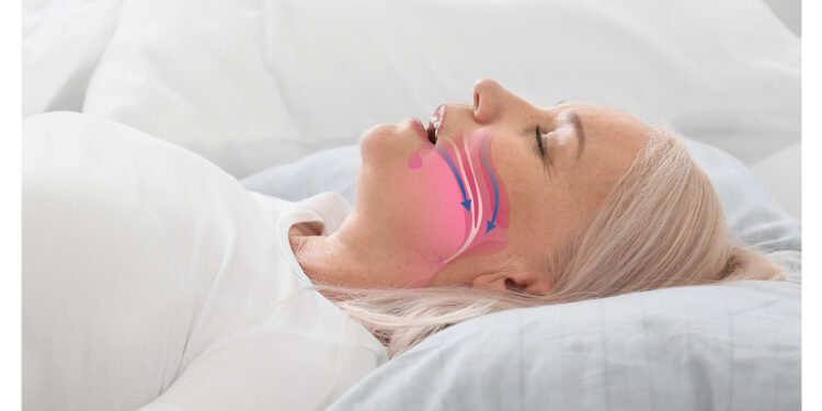 Nuevo estudio revela que un aerosol nasal podría atenuar la gravedad de la apnea del sueño