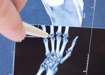 ABC de la artritis reumatoide juvenil: causas, síntomas, diagnóstico y tratamiento