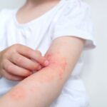 México: Llamado para evitar la automedicación en dermatitis atópica en infancias y adolescencias