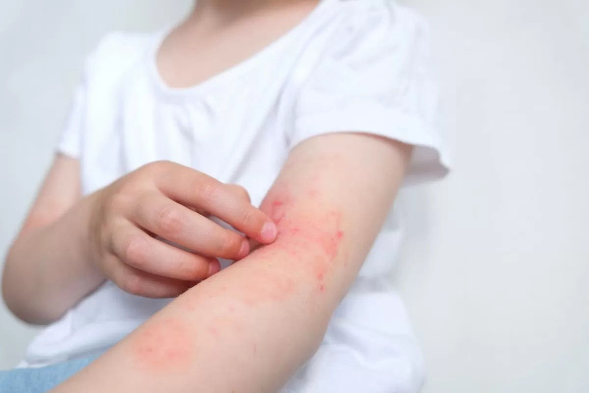 México: Llamado para evitar la automedicación en dermatitis atópica en infancias y adolescencias