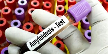 Amiloidosis por transtiretina una enfermedad hereditaria que afecta el sistema nervioso y cardíaco
