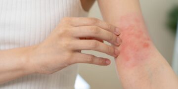 FDA aprueba la crema de roflumilast al 0,15% para el eczema en pacientes desde los 6 años