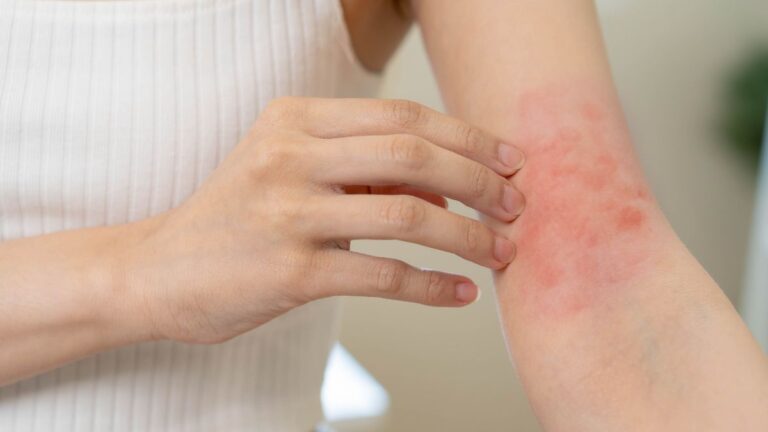 FDA aprueba la crema de roflumilast al 0,15% para el eczema en pacientes desde los 6 años