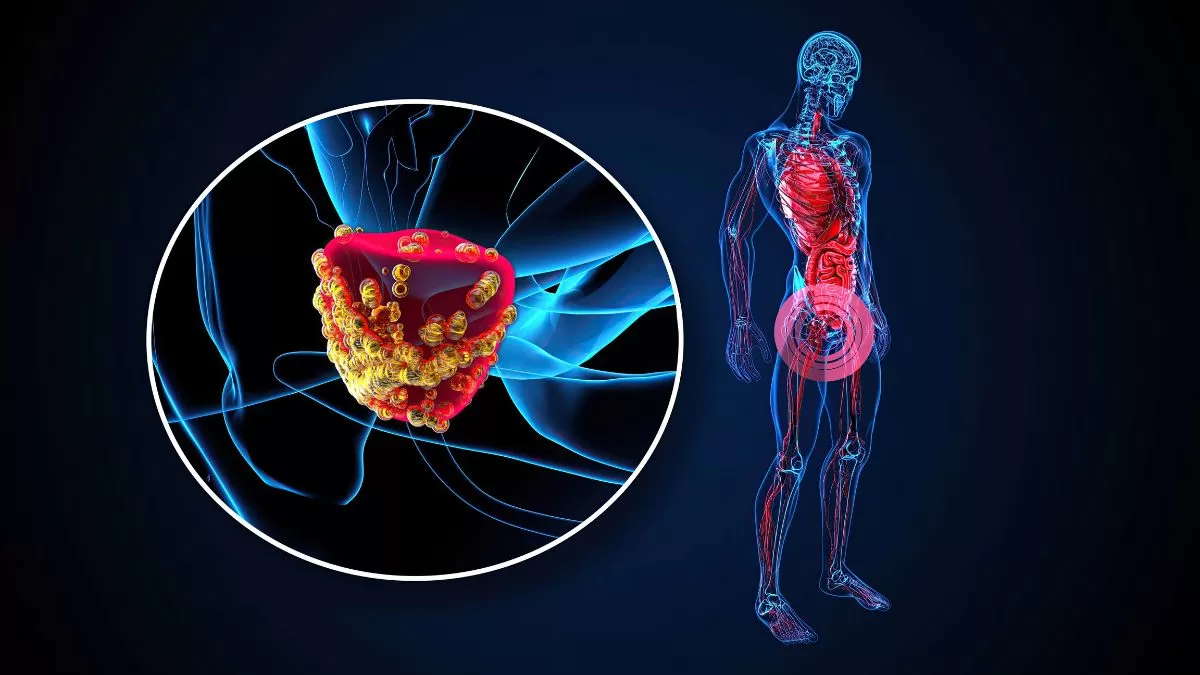 Herramienta de IA para predecir la recurrencia del cáncer de próstata con anticipación