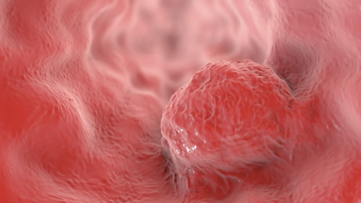 La IA revoluciona la detección de cáncer de esófago con ENDOANGEL-ELD