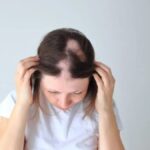 FDA aprobó de JAK Deuruxolitinib para la alopecia areata