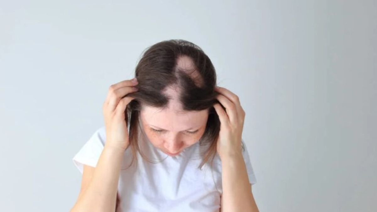 FDA aprobó de JAK Deuruxolitinib para la alopecia areata
