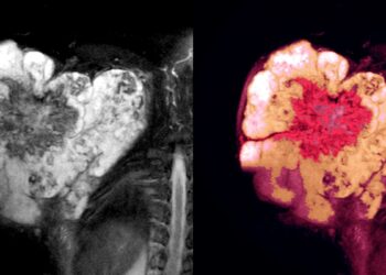 Tecelra: la revolución en terapias celulares para el sarcoma sinovial aprobada por la FDA