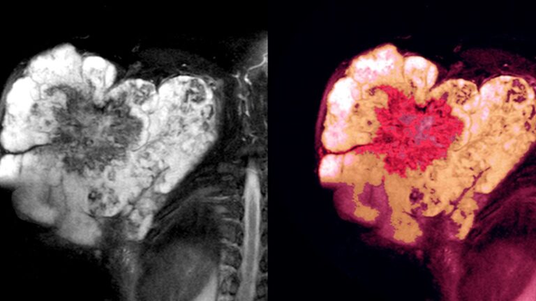 Tecelra: la revolución en terapias celulares para el sarcoma sinovial aprobada por la FDA