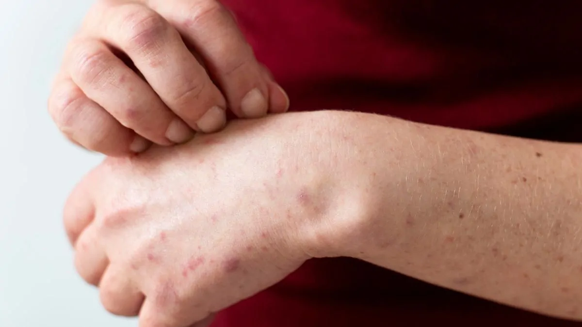La FDA aprueba Ebglyss para el tratamiento de la dermatitis atópica de moderada a grave
