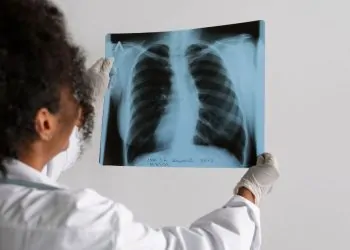 La tuberculosis resurge como principal causa de muerte por enfermedad infecciosa: OMS