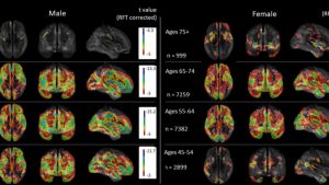 Riesgo cardiovascular adelanta el deterioro cerebral en hombres. Foto BMJ