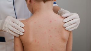 Brote de sarampion en Texas crece a 124 casos y genera alerta por posible expansion
