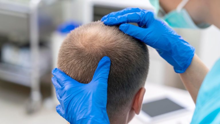 EMA revisa fármacos para alopecia tras reportes de ideación suicida