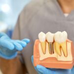 Implantes dentales el 5.6 % falla en dos años, según nuevo estudio