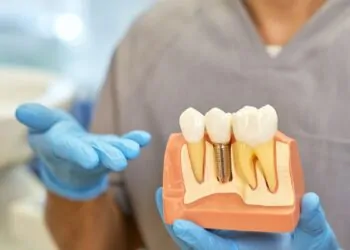 Implantes dentales el 5.6 % falla en dos años, según nuevo estudio