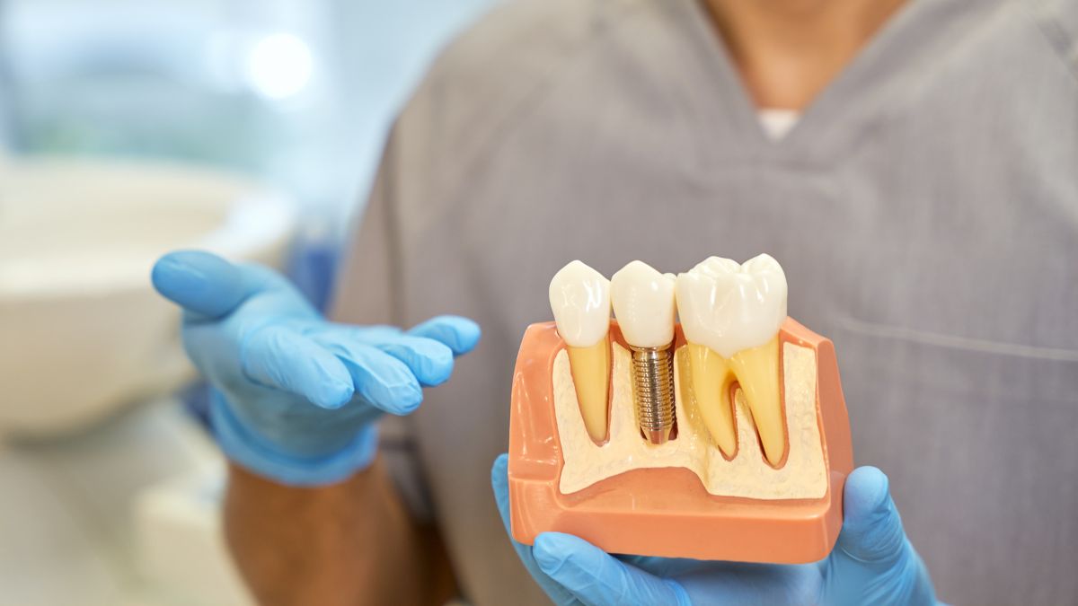 Implantes dentales el 5.6 % falla en dos años, según nuevo estudio