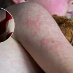 Estados Unidos enfrenta una crisis de salud pública con más de 1.000 casos de sarampión y brotes activos en 11 estados