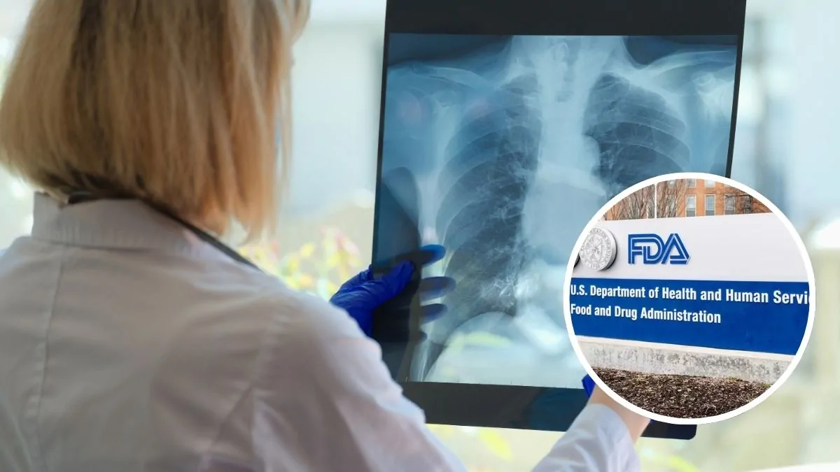 La FDA aprueba Nucala como primer biológico para EPOC eosinofílica inadecuadamente controlada