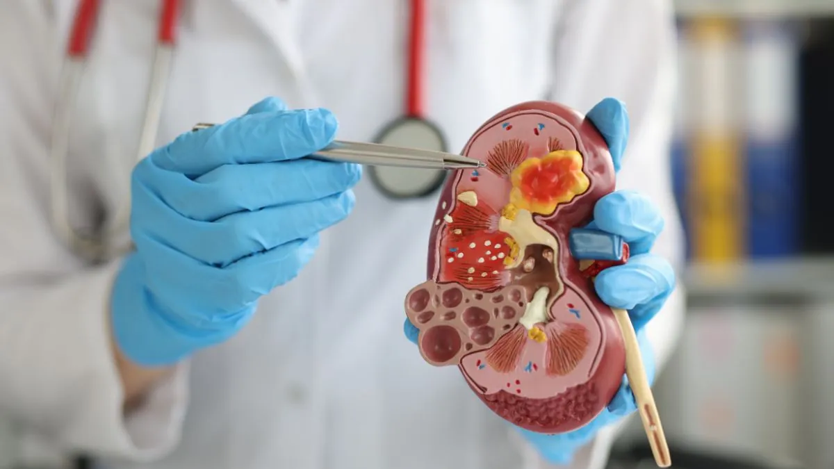 Día Mundial del Cáncer de Riñón: avances en prevención, diagnóstico y tratamiento