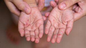 INS refuerza vigilancia ante incremento de casos de mano, pies y boca en Colombia