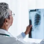 Corticosteroides e inmunoterapia una combinación con efectos adversos en pacientes con cáncer de pulmón