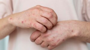 Lupus eritematoso sistémico en Colombia desafíos clínicos y barreras en la atención integral